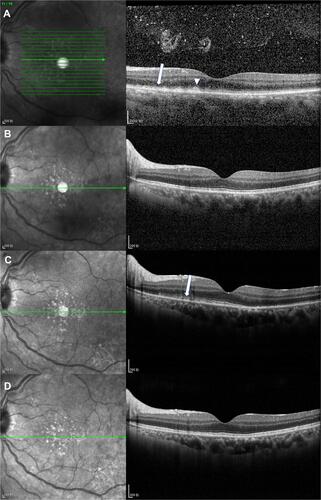 Figure 4 OCT images of eye 3. (A) Before intravitreal methotrexate, OCT revealed outer retina fuzzy borders (arrow) and focal subretinal deposits. Vitreous cells were also observed (arrow head). (B) After induction phase, the above two abnormalities disappeared. (C) After 19 injections, outer retina fuzzy borders appeared again (arrow). (D) After a second consolidation phase, the retinal structure returned to almost normal.