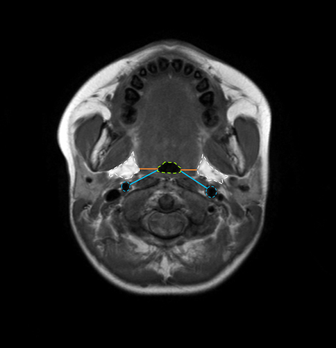 Figure 2 Measurement of LPW thickness on the transverse (orange lines) and oblique (blue lines) dimensions on MRI. Airway, lateral parapharyngeal fat pads, and internal carotid arteries are indicated by the green, white, and blue dashed lines, respectively.