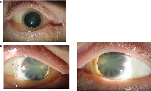 Figure 2. a–c. Photos showing conjunctival chemosis and cataract in a male patient 60 years of age with Fabry disease (FD). Twenty years earlier he had experienced problems with a swollen eye. An ophthalmologist noticed eye lid oedema, chemosis and corneal horizontal pigmentation but suspected allergy. FD was diagnosed a few years later due to other organ manifestations.