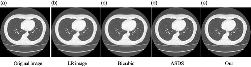 Figure 5. Comparison of the reconstructed images of various methods for noiseless medical image (Equation3(3) α=argminα∥α∥1,s.t.∥x−Φα∥2≤ε(3) ) (a) Original image (b) LR image (c) Bicubic (d) ASDS (e) Our.