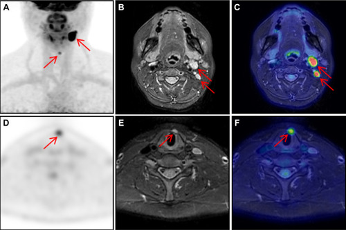 Figure 1 A 43-year-old female patient with a history of papillary thyroid carcinoma who underwent thyroidectomy and RAI therapy. Her serum Tg level was 38.72 ng/mL. The images ((A) maximal intensity projection; (C and F) PET/MR fusion; (D) PET image; arrows) showed cervical lymph nodes with increased FDG uptake (SUVmax, 15.6). Cervical lymph nodes can be identified the MRI ((B and E) axial T2-weighted with fat suppression, arrows). The patient underwent neck surgery, and pathology results confirmed lymph node metastasis. The serum Tg levels decreased in the later follow-up.