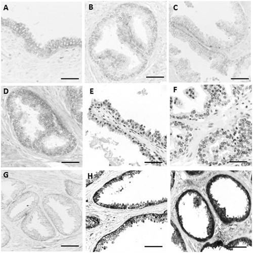 Figure 2. Expression of Noxa (A,B), p27 (C,D), pRb (E,F), mp53 (G–I) in normal prostate (G), BPH (B,D,F,I) and prostate cancer (C–F). Scale bars: 25 μm (A,D,G,H,I) and 20 μm (B,C,E,F).