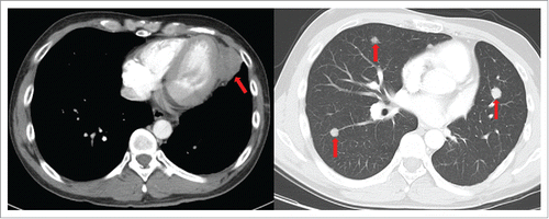 Figure 5. CT revealed the enlarged pleural mass (4.1 × 3.4cm), bilateral lung nodules in September 2016.