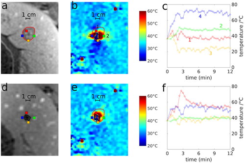 Figure 3. Exemplary liver ablation (swine 1, first ablation) with ablation zone determined by T1w-CE imaging (red line in (a)) and segmented area of signal void in MR-thermometry (black line in (d)). The resulting temperature map at the end of ablation (b and e) and corresponding time-dependent temperature curves (c, f) at four different positions (1: red, 2: green, 3: yellow and 4: blue dot) without (first row) and with (second row) susceptibility correction are shown.