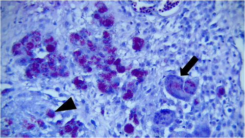 Figure 3. Hepatic granuloma. Large numbers of acid-fast organisms are seen within the infiltrated macrophages (arrowhead) and multinucleated giant cells (arrow) (Ziehl-Neelsen staining, ×400).