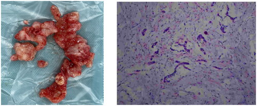 Figure 4. We can see odontogenic epithelial stripes.