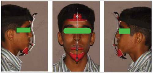 Figure 1. Maxillary protraction procedure.