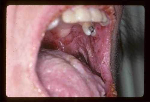 Figure 1 Oral manifestations of paraneoplastic pemphigus. Massive erosions of the oral mucosa.