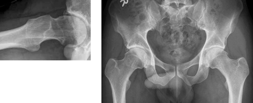 Figure 35. Coxa recta in 35 year old male. Straight portion of femoral is seen on both AP pelvis and axial view (left). Note early degenerative changes. Head/neck ratio = 1.3 Orangutan (1.8) Gorilla (1.5) Chimpanzee (1.5) Homo (1.35)