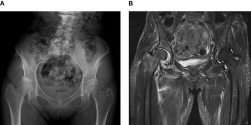 Figure 1 (A) A chest X-ray imaging showed slight deformation of the right femoral bone head and bone joint fissure narrowing. (B) Magnetic resonance imaging detected T2 prolongation in the right femoral bone head, synovial fluid retention, and bone joint fissure narrowing. These findings were not observed in the previous roentgenological imaging five months ago. The patient was diagnosed with right rapidly destructive coxarthrosis as a side effect of crizotinib.