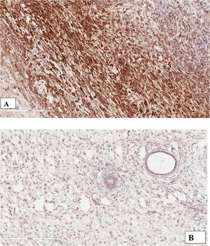 Figure 5 (A) Shows a tumor positive for p53, and (B) Shows a tumor negative for p53 all images were taken at x200.