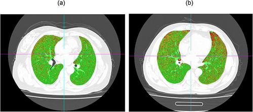 Figure 3 Quantitative CT of emphysema. Notes: lung voxels ≤ −950 HU in CT value are red color-coded; lung voxels> −950 HU and 910HU in CT value are yellow color-coded; lung voxels> −910 HU in CT value are green color-coded; (a) A low-risk COPD participant with mild emphysema. (b) A high-risk COPD participant with moderate emphysema.