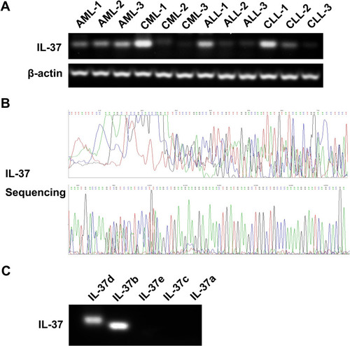Figure 1 IL-37 mRNA levels in bone marrow of patients with leukemia. (A) IL-37 mRNA levels in patients with different types of leukemia by semiquantitative PCR. (B) Sanger sequencing for PCR products of IL-37. (C) mRNA levels of five IL-37 isoforms.