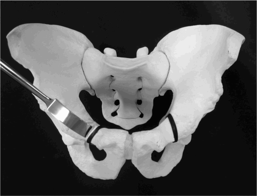 Figure 1. Cutting angle of pubic osteotomy (black line). The angle of the pubic osteotomy (right hip) is modified, with a 30‐degree inclination to the horizontal line (M group). The conventional pubic osteotomy (left hip) has a 90‐degree inclination to the horizontal line (C group).