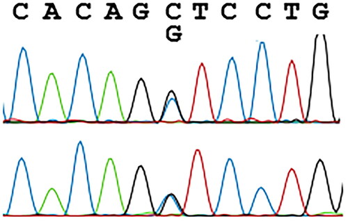 Figure 3. Sanger sequencing of HBB revealing the missense variant. The upper strand is the forward sequence, the lower the reverse sequence. Evaluations were carried out using Applied Biosystems 3500 Genetic Analyzer (Life Technologies, Carlsbad, CA).