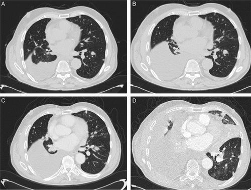 Figure 1.  Patient 1. A. Pleural and intrapulmonary metastases with pleural effusion, short before discontinuation of sorafenib. B. Progression of number and size of pulmonary metastases with increased pleural effusion, one week after discontinuation of sorafenib. C. Latest CT before the second stop of sorafenib. D. Progressive disease after discontinuation of sorafenib with pulmonary, pleural and lymph node metastases, pleural and pericardial effusion.