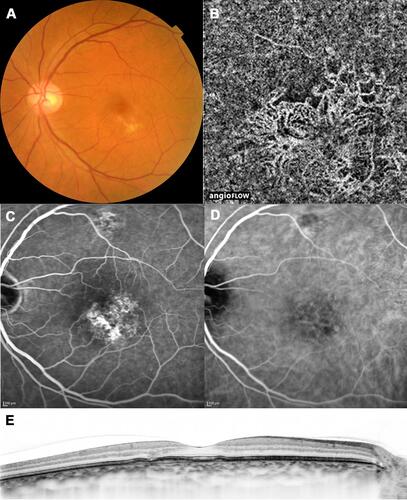 Figure 3 A case with pachychoroid neovasculopathy (after treatment). Images of the same patient as in Figure 2, acquired 12 months after initial treatment. The best-corrected visual acuity had improved to 20/16. (A) Color fundus photograph shows resolution of subretinal hemorrhage and serous retinal detachment. (B) Optical coherence tomography (OCT) angiography image shows choroidal neovascularization. (C) Late-phase fluorescein angiography image shows reduction of leakage. (D) Late-phase indocyanine green angiography image. (E) Enhanced-depth imaging OCT image shows resolution of serous retinal detachment. Subfoveal choroidal thickness = 348 μm, central retinal thickness = 206 μm.