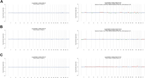 Figure 4 (A and B) Copy number variation in blood and CSF in two meningeal metastasis patients with genomic stability. (C) Copy number variation in blood and CSF in brain parenchymal metastasis case with genomic stability. The log2 ratio value is plotted on the y-axis; the x-axis represents chromosomes. Red indicates copy number gain, green indicates copy number loss, and blue indicates no change.