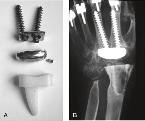 Figure 12. A) The Guepar wrist arthroplasty with microscrew. B) Radiologically loose distal and proximal components. (Courtesy of Dr Hubach.)