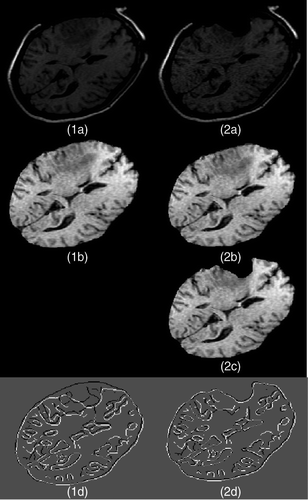 Figure 13. Two-dimensional experimental results for modeling of the first resection in Case 3. (1a) The second iMR image. (2a) The third iMR image. (1b) The image resulting from brain-shift modeling [identical to Figure 6(2b)]. (2b) Deformation of (1b) using the surface displacement field of the biomechanical model, computed via FEM. (We say “surface” as we are working in two dimensions.) (2c) Deformation of (1b) with resection, performed by masking (2b) with the brain region segmented from the third iMR image (2a). (1d) Juxtaposition of Canny edges of (1b) and the brain part of (2a). (2d) Juxtaposition of Canny edges of (2c) and the brain part of (2a).