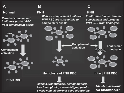 Figure 6 The rationale for eculizumab in paroxysmal nocturnal hemoglobinuria (PNH). A. Normal red blood cells (RBCs) are protected from complement attack by CD59. B. PNH RBCs are susceptible to complement attack due to lack of CD59, resulting in hemolysis and consequent clinical manifestations. C. Eculizumab blocks the complement cascade inhibiting MAC formation; thus, even upon complement activation, PNH RBCs are protected from hemolysis, thus resulting in hemoglobin stabilization and reduction of thromboembolisms.