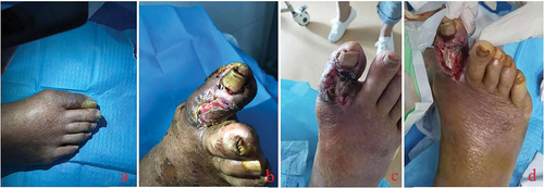 Figure 3. Most diabetic foot wounds start from lesions of the small blood vessels at the distal end of the affected limb. The destruction of the local blood supply impairs survival of the skin and soft tissue of the toe. At this time, the skin of the affected toe is often darkened (a), and mild paresthesia is often combined. Then, local skin necrosis occurs, subcutaneous tissue is exposed, ulcer wounds are formed (b), and the sensory function of the affected toe is impaired. Due to impaired sensory function, the pain is not severe despite the severe wound. The continuous necrosis of the surrounding tissue and the high probability of trauma make the wound develop further, and tendons and bones are gradually exposed (c, d). Local infection can occur at various stages after wound formation.