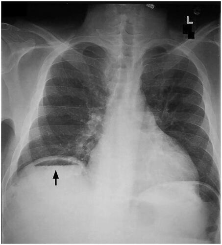 Figure 1. Chest x-ray of the patient shows the presence of air located under the diaphragm.