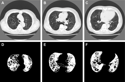 Figure S3 Representative computed tomography (CT) images and results of preprocessing of the upper, middle, and lower lung fields in a 77-year-old man with COPD.Notes: Forced expiratory volume in 1 second (FEV1)/forced vital capacity; FEV1; b0, b1, R; and the percentage of low-attenuation lung area were 42.8%; 50.2%; 1,420, 321, 0.226; and 26.5%, respectively (b0, the zero-dimensional Betti number; b1, the one-dimensional Betti number; R, b1/b0). The CT images and the binarized images are shown in (A–C) and (D–F), respectively.