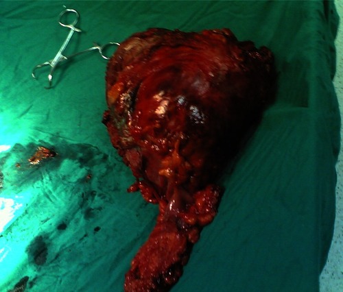 Figure 1 The anterior aspect of a GIST presenting as a huge abdominal mass attached to the left half of transverse colon with its mesocolon, body and tail of pancreas, and a part of the small intestine removed from a 28-year-old female.