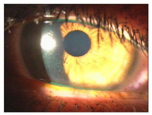 Figure 3 Dry eye in a diabetic patient as a result of diabetic corneal neuropathy.
