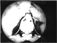 Figure 1. Imagination of a patient's adrenal gland on CT.