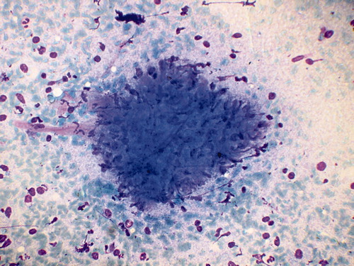 FIGURE 3. Cervical node biopsy showing granuloma with multinucleate giant cells, degenerated inflammatory cells, and necrosis.