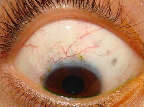 Figure 7 Functioning bleb of a group A patient (mitomycin C and bevacizumab) postoperatively.