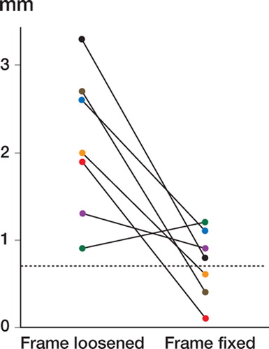 Figure 3:3 Sagittal intervertebral translations for seven patients measured both with the external frame loosened and with the frame fixed. The dotted line indicates the accuracy for sagittal translation, 0.7 mm. (Reproduced with permission from Spine).