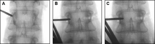 Figure 4 X-ray films of true AP view percutaneous pedicle screw insertion.