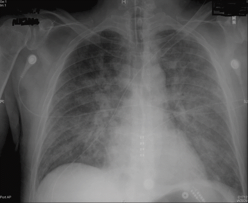 Fig. 2.  Antero-posterior view of the chest taken 30 hours after administration of phenol showing bilateral alveolar opacities. There is an endotracheal tube in place.
