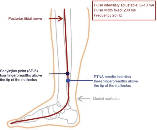 Figure 1 Drawing showing the location of the Sanyinjiao point, or Spleen 6 (SP-6), the percutaneous tibial nerve stimulation (PTNS) point, and the technical details.