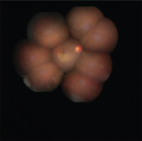 FIGURE 3  Fundus photograph of right eye post-therapy showing resolution of vasculitis and hemorrhage after 25 days of treatment.