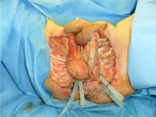 Figure 4 The wound care: debridement – shown is the 8th day post-surgery.