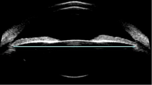 Figure 5 Sulcus-to-sulcus diameter (light blue line) measurement with ultrasound biomicroscopy. Courtesy of STAAR Surgical.