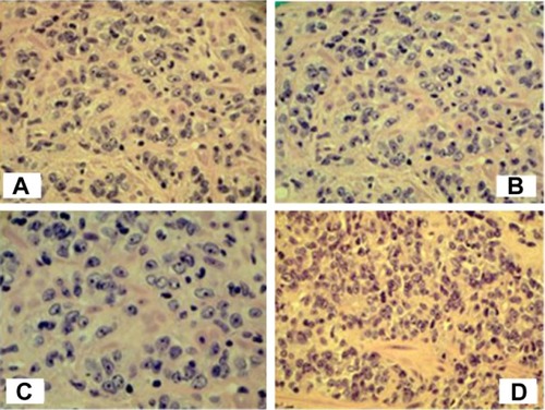 Figure 1 Prostate biopsy – Gleason 9 (5+4) prostate cancer. (A) Hematoxylin and eosin, 200× (10× eyepiece, 20× objective). (B) Hematoxylin and eosin, 200× (10× eyepiece, 20× objective). (C) Hematoxylin and eosin, 400× (10× eyepiece, 40× objective). (D) Hematoxylin and eosin, 200× (10× eyepiece, 200× objective).