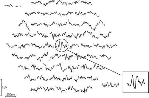 Figure 1 Pattern reversal multifocal visual evoked potentials recorded from the fellow left eye of Case 10 in Table 1. The inset shows a normal foveal trace without attenuation and normal latency.