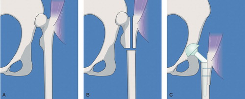 Figure 2. A. CDH grade D. B. Consistent with the preoperative templating, an extended trochanteric osteotomy is performed followed by a transverse osteotomy of the femur. The medial segment is removed. C. A straight stem is inserted and the acetabular component is placed at the level of the true acetabulum. The greater trochanter is advanced distally until the gluteus medius muscle is tight, and then it is fixated with 2 screws.