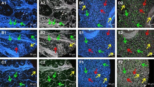 Figure 4 Multiplexed spectrum analysis of QD probe-based multiple molecular imaging.Notes: (A1, B1, C1, D1, E1 and F1) The conventional fluorescent images of QD probe-based multiple molecular imaging. Infiltrating macrophages (green arrows), LOX (yellow arrows) and neovessels (red arrows) are labeled simultaneously in GC tissues with nanoprobes QDs-525, QDs-585 and QDs-655, respectively. (A2, B2, C2, D2, E2 and F2) Unmixed composite multiple spectrum image of QD probe-based multiple molecular imaging. Infiltrating macrophages (green arrows), LOX (yellow arrows) and neovessels (red arrows) are labeled simultaneously in GC tissues with nanoprobes QDs-525, QDs-585 and QDs-655, respectively. The unmixed composite multiple spectrum image shows more information. Magnification: 200× (A1–F2). Scale bar: 50 μm for (A1–F2).Abbreviations: QD, quantum dot; LOX, lysyl oxidase; GC, gastric cancer.