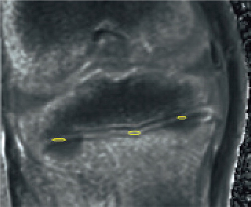 Figure 2. Water content. This image corresponds to an MR done immediately after the procedure; physis disruption is not evident. Water content was calculated in the ablation sites (yellow circles) and in a non-ablated region (in the middle) to compare the effect of the ablation.