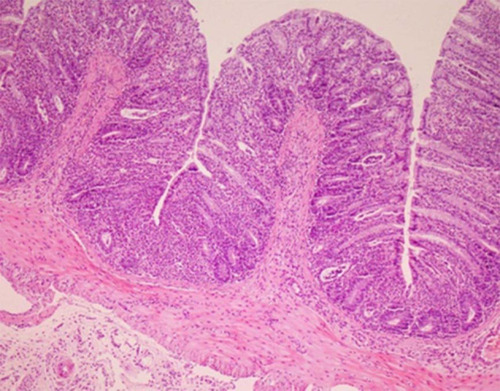 Figure 5 Microscopic section shows mild transmural acute inflammation with basal crypt damage and complete regeneration after mastic oil orally consumption. (Hematoxylin and Eosin, 100×).