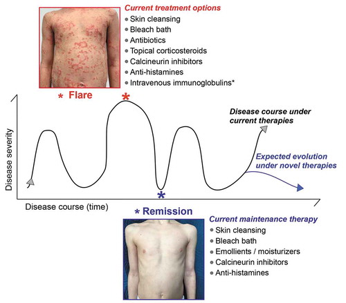 Figure 5. Common therapeutic approaches to breaking the vicious cycle of epidermal barrier defects and inflammation in Netherton syndrome. A schematic illustrating disease progression with time especially observed in NS patients with ILC. Netherton syndrome patients can experience disease exacerbation (flares), during which skin lesions appear or aggravate, separated by temporary remissions, during which skin lesions improve or disappear transiently. The duration of flares and remissions can vary from patient to patient. The time between each peak of flare is also variable and can range from 1 week to several months. Likewise, flare intensity for a given patient can fluctuate. The images show abdomen skin of the same NS patient during flare and remission. Although in this particular case remission is complete, other NS patients often show incomplete remission. The current, common therapeutic regimes for each disease state are indicated. These current therapies do not prevent the relapse of flares nor make them less severe, but they can help reduce their frequency. Future, novel therapies for Netherton syndrome are expected to prevent flares and/or reduce their intensity and frequency