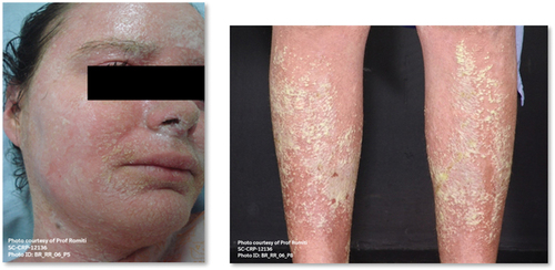 Figure 1. The life-threatening nature of GPP flares is illustrated by this 18-year-old woman with relapsing GPP, who presented with a severe flare. This progressed to sepsis with massive pulmonary involvement, resulting in the death. (image on the right side is reproduced from Romiti et al. Anais Brasileiros de dermatologia 2022;97:63–74. Published under CCBY license https://creativecommons.org/licenses/by/4.0/; left image provided with permission, courtesy of Professor Ricardo Romiti (University of São Paulo, Brazil).