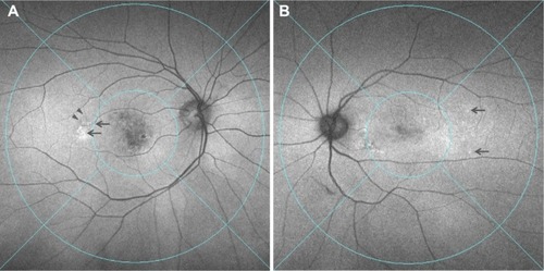 Figure 3 Two representative cases of CVH(+) AMD showing FAF abnormalities in the midperipheral fundus.