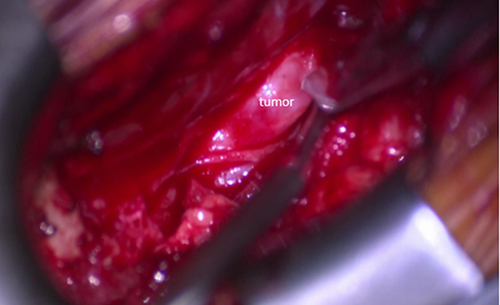 Figure 2 The right L5 root tumor is exposed. A number 11 sharp knife was used to make a small hole to open the dura.